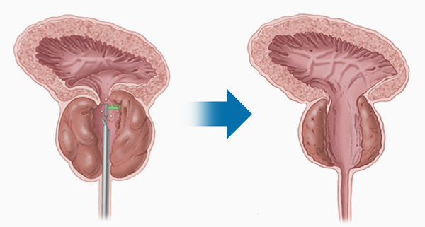 画期的手術法（PVP）