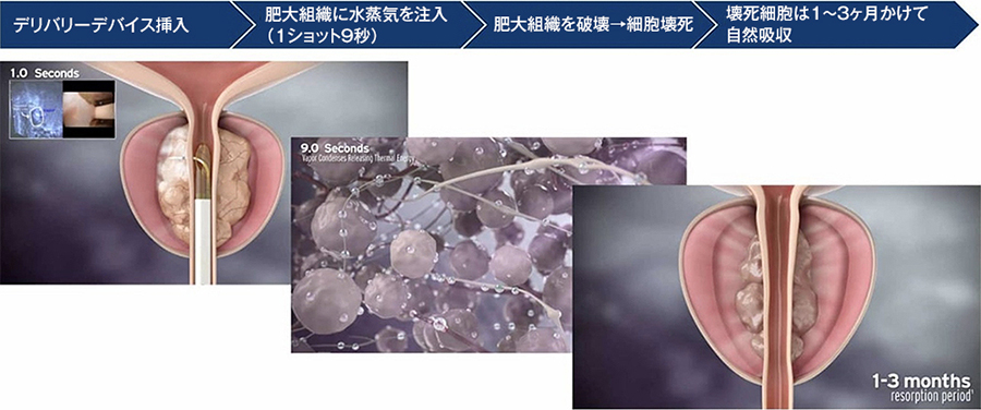 レーザー蒸散術による前立腺