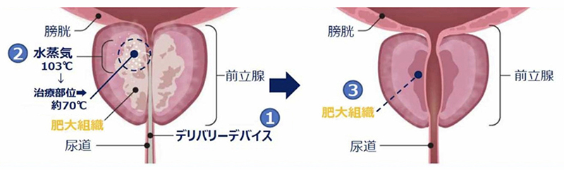 Rezumによる前立腺手術