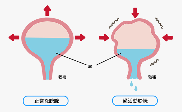 画期的手術法（PVP）